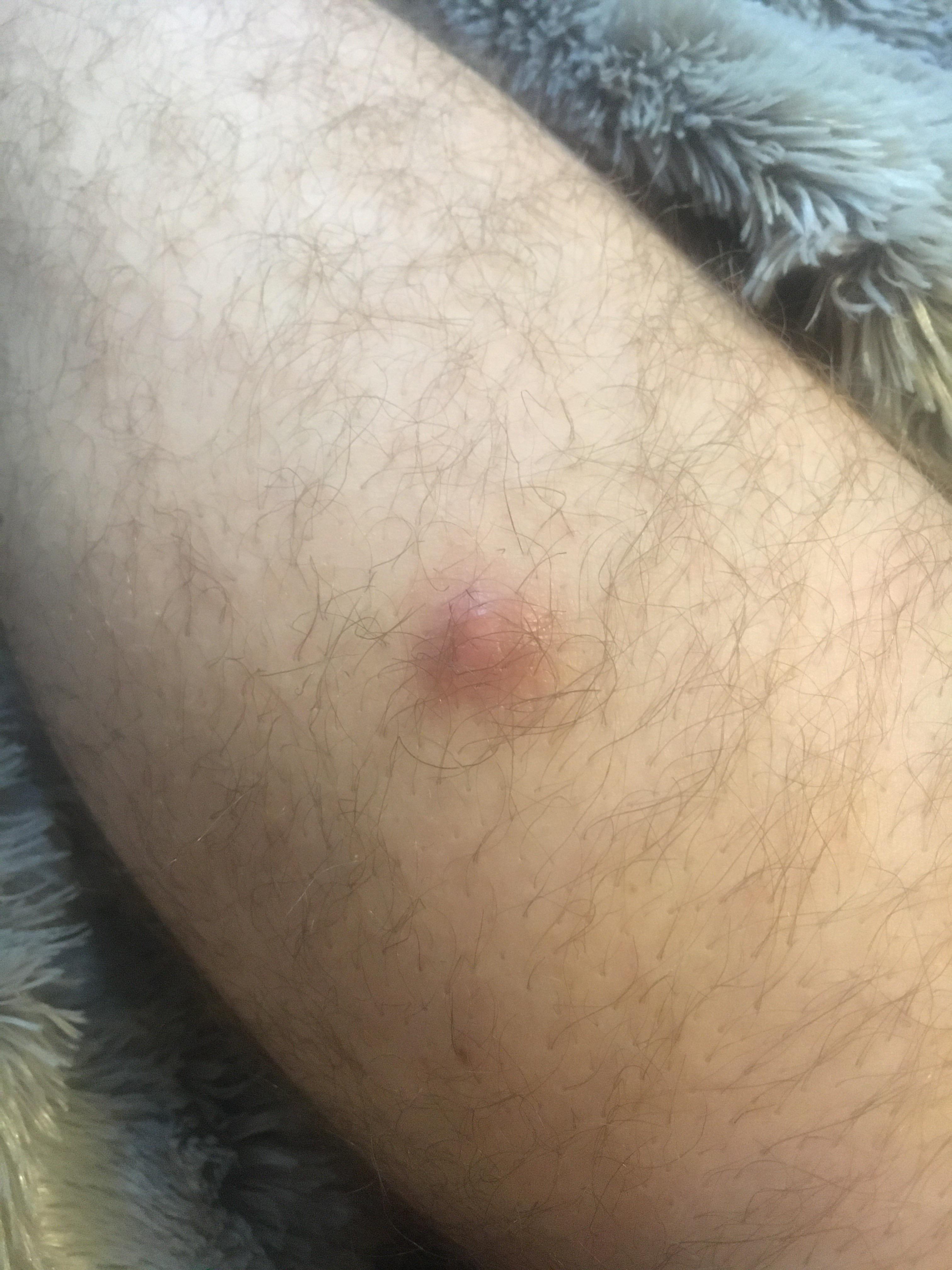 Prone to ingrown hairs. Developed a strange bump under the skin. | Scrolller