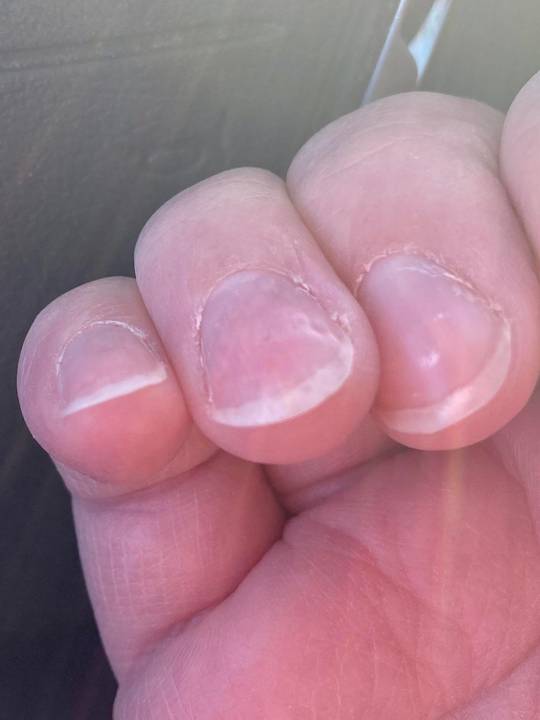 My skin has been ok recently but my nails are very brittle and bumpy. |  Scrolller