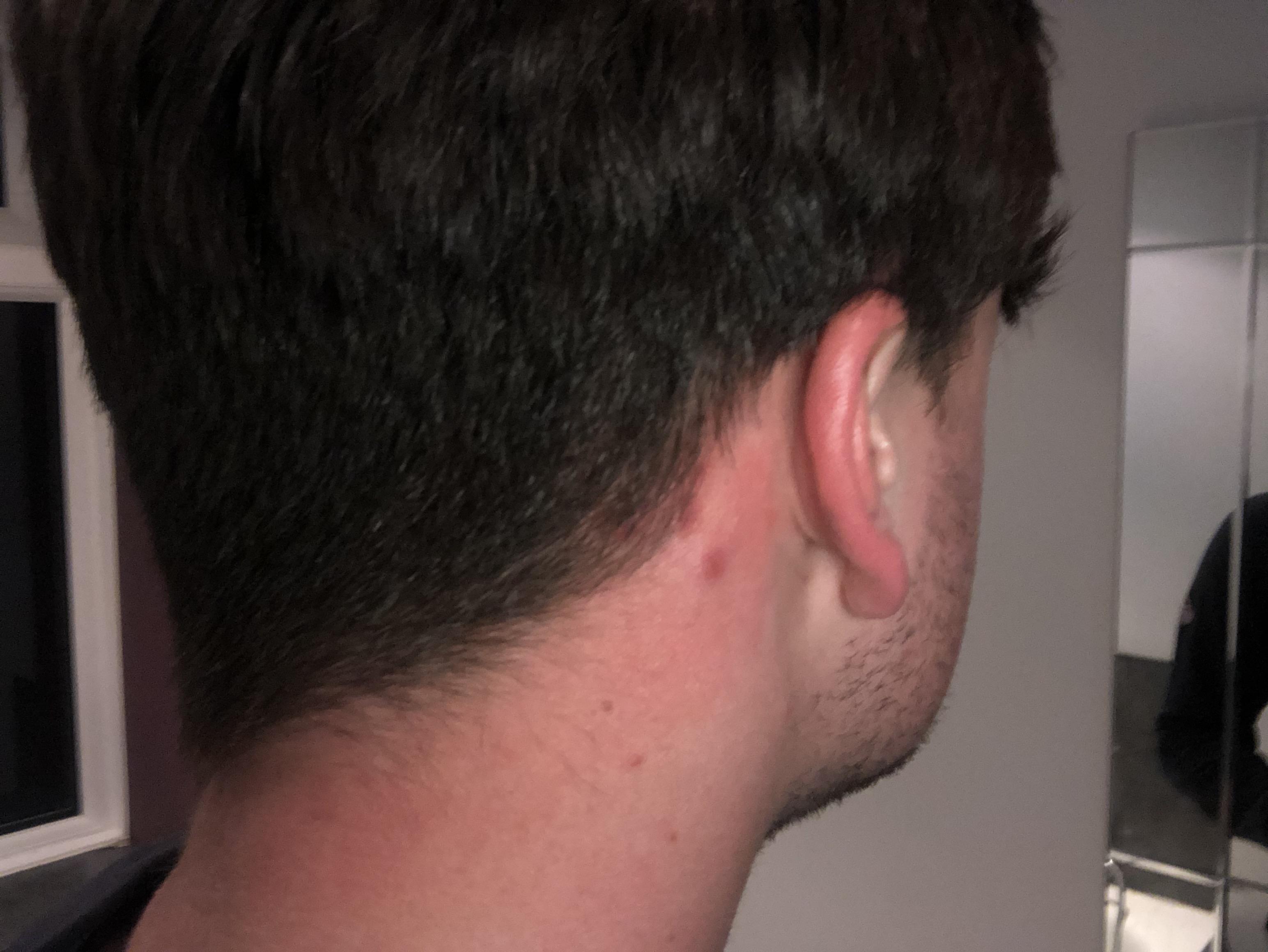 Spots in my neck hair line? I get spots on back of scalp and on top of my  head. I've recently been getting larger much more sore spots around my hair  line,
